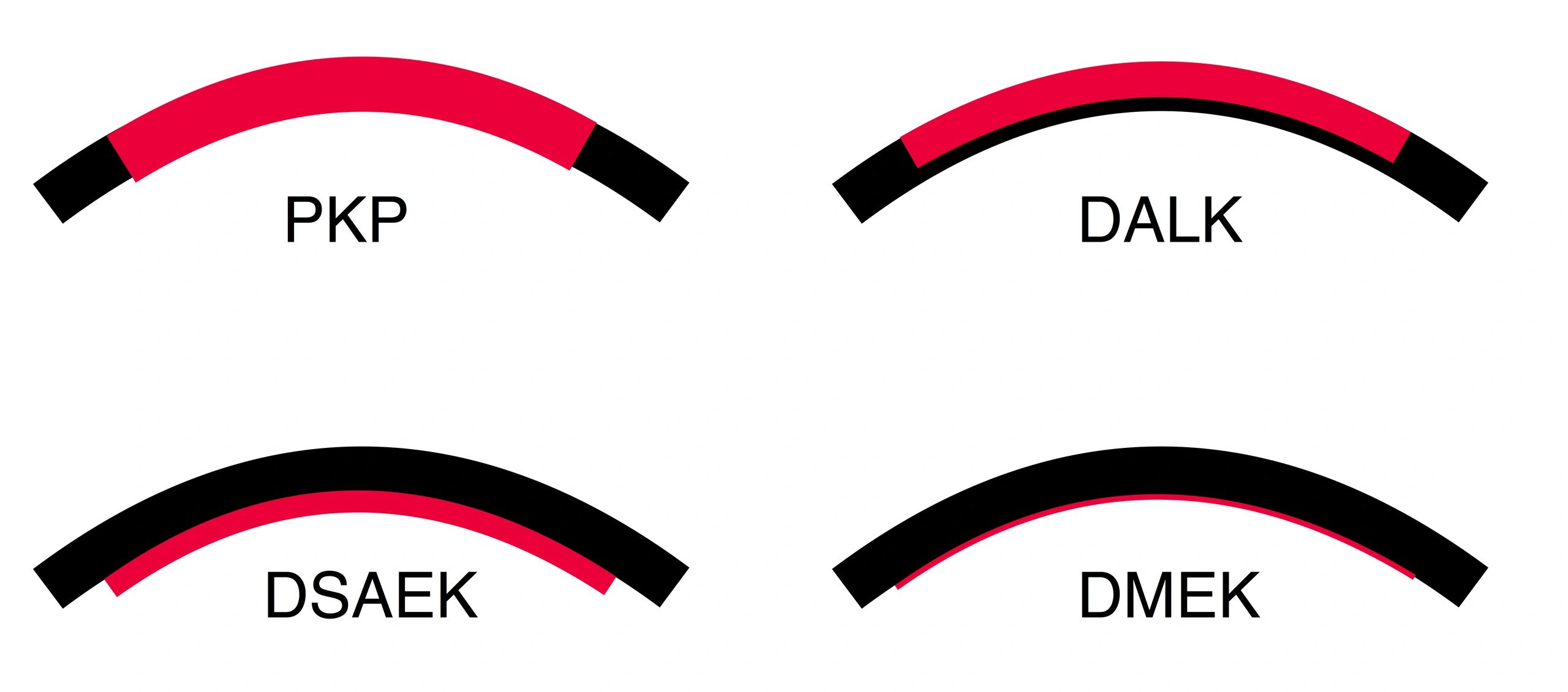 PKP DALK DSAEK DMEK What Is The Difference pkp-dalk-dsaek-dmek-what-is-the-difference